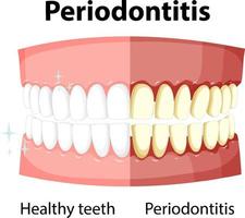 infographic van mens met parodontitis vector