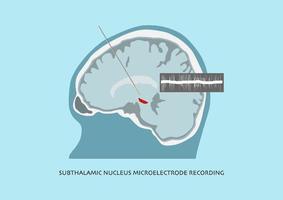 hersenopname in de subthalamische kern voor parkinsonchirurgie. vector