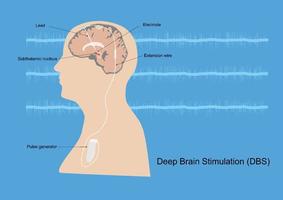 diepe hersenstimulatie voor de ziekte van parkinson vector