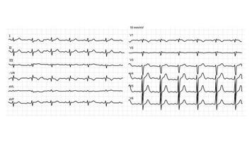 illustratie van normaal elektrocardiogram op witte achtergrond. vector