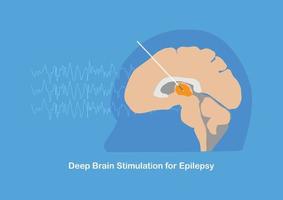 diepe hersenstimulatie voor epilepsie of epileptische aanvallen vector