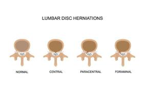 type lumbale hernia's vector