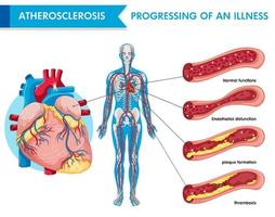 atherosclerose progressie van een ziekte vector