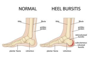 calcaneale bursitis. voet met normale hiel en voet met haglund's misvorming en bursitis. vector