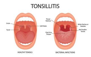 angina, faryngitis en tonsillitis. tonsillitis is bacterieel. tonsil infectie. open mond, anatomie. vector