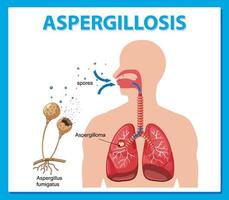 diagram met aspergillus-infectie vector