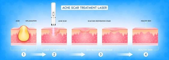 acne litteken vasculaire laserbehandeling. ontsteking geassocieerd met puistjes. de structuur van de huid acne litteken. medische schoonheid huidverzorging concept. 3D-vectorillustratie. vector