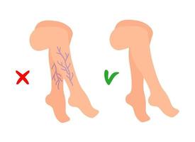 spataderen in de benen. vasculaire of spataderen en gezonde schone aderen. platte vectorillustratie cartoon geïsoleerd op een witte achtergrond. geneeskunde en gezondheidszorg concept. beauty spa-procedure. vector