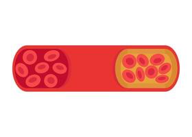 verandering van vat van normale naar cholesterol-geblokkeerde slagader. bloedstolsel, trombus, atherosclerotische plaque. diepe veneuze trombose dvt of arterieel stolsel, bloedvaatstroom. geblokkeerde circulatie. vector