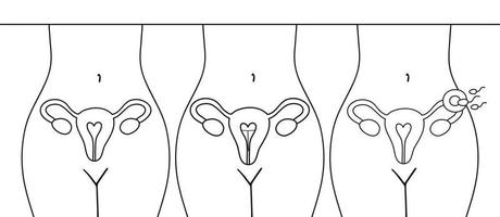 bevruchting icoon. baarmoeder, sperma, inseminatie. bevruchting in de eileider. de methode van iud-anticonceptie staat niet op zichzelf. vector