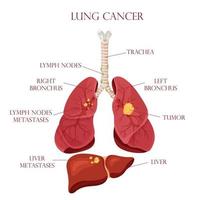 diagram longkanker ziekte. concept ziekte menselijke interne organen. vectorillustratie, cartoon stijl. vector