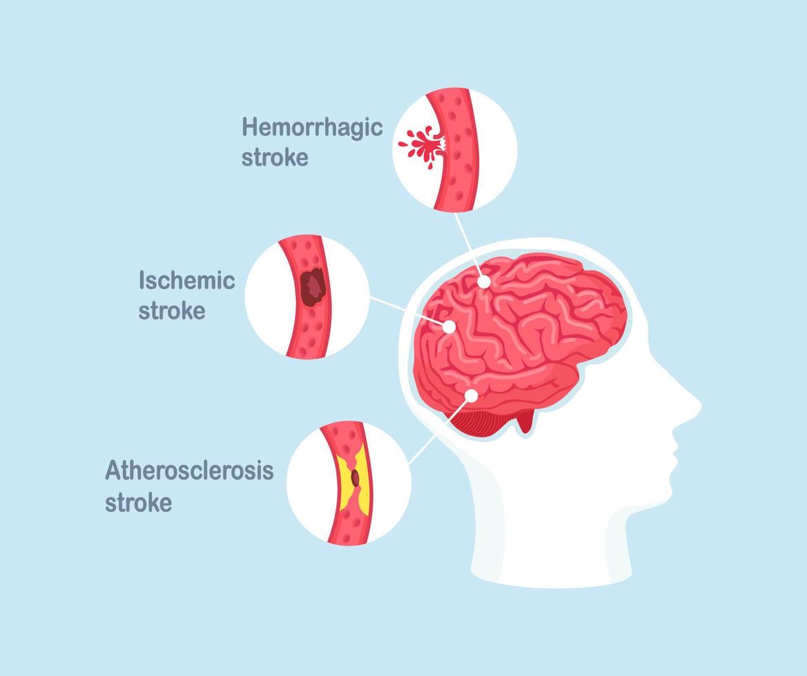 typer av stroke hos människan. ischemisk, ateroskleros och hemorragisk strokesjukdom vektor