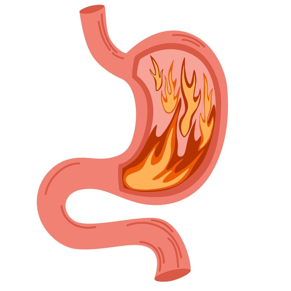 mänsklig mage i brand. ohälsosam mage koncept. halsbränna, sjukdom, obehag, smärta. platt vektorillustration isolerade på vitt vektor