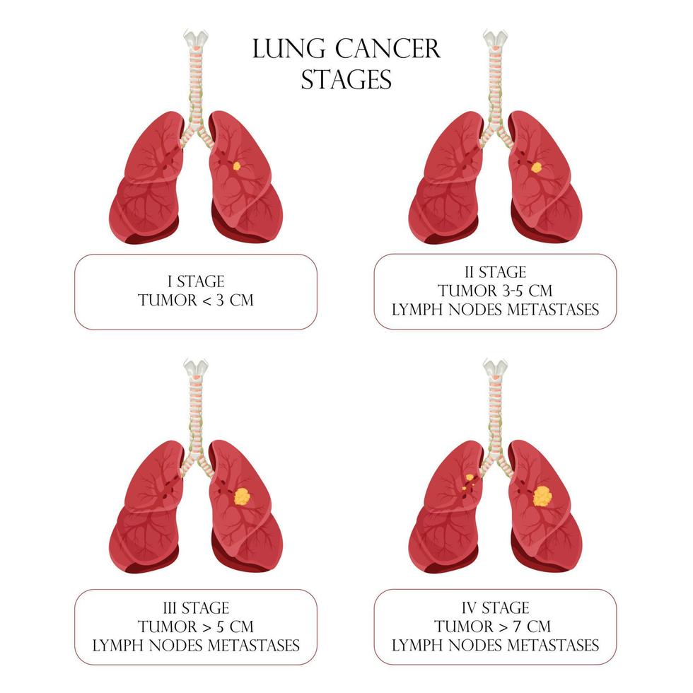Lungenkrebs Stadien. Konzeptkrankheiten der inneren Organe des Menschen. Cartoon-Stil, Vektorillustration. vektor