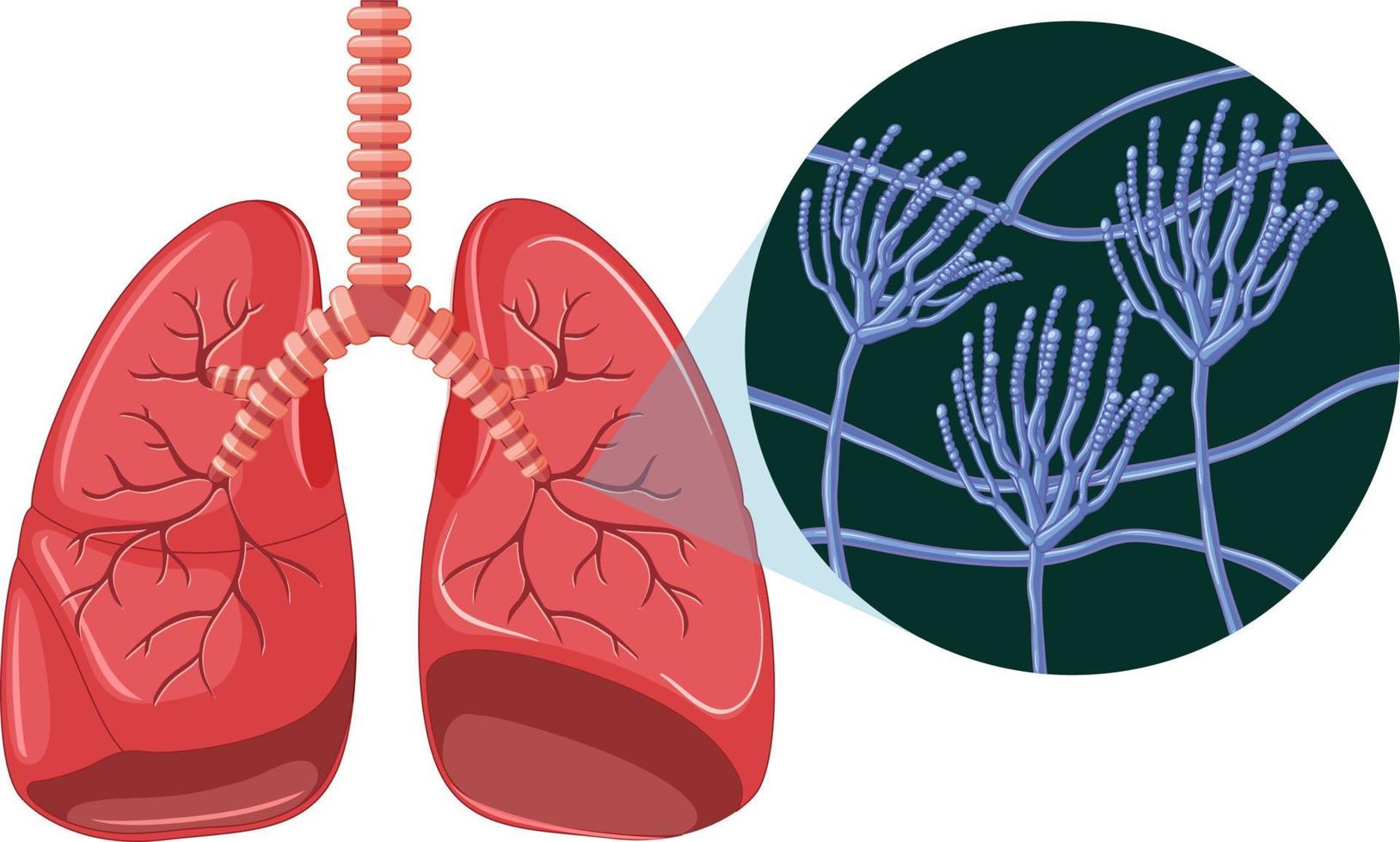 die Schimmelpilzsporen wachsen in der menschlichen Lunge vektor