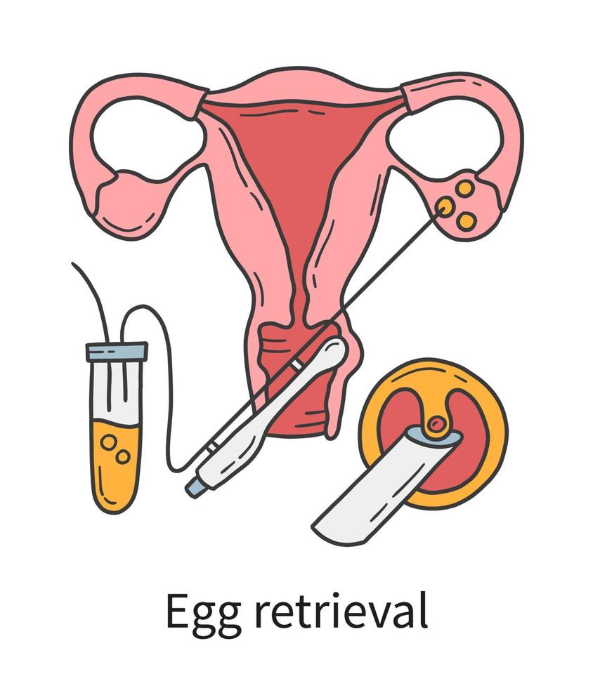 Eizellentnahme und transvaginale Oozytenentnahme aus Eierstöcken, In-vitro-Fertilisation vektor