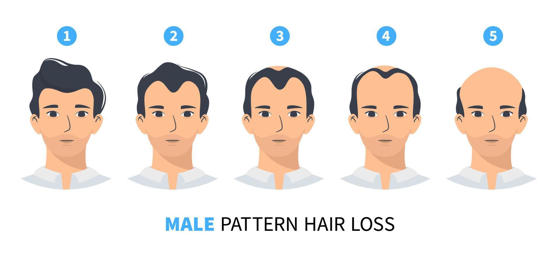 håravfall stadier, androgen alopeci manligt mönster. steg av skallighet vektor infographic i platt stil med en man. mphl