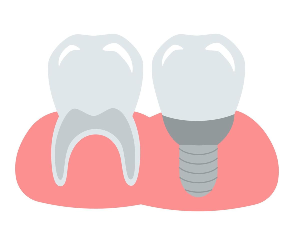 gesunder, sauberer, starker Zahn und ein Implantat in einem rosafarbenen Zahnfleisch. Vektorzahnillustration für Design und Dekoration. vektor