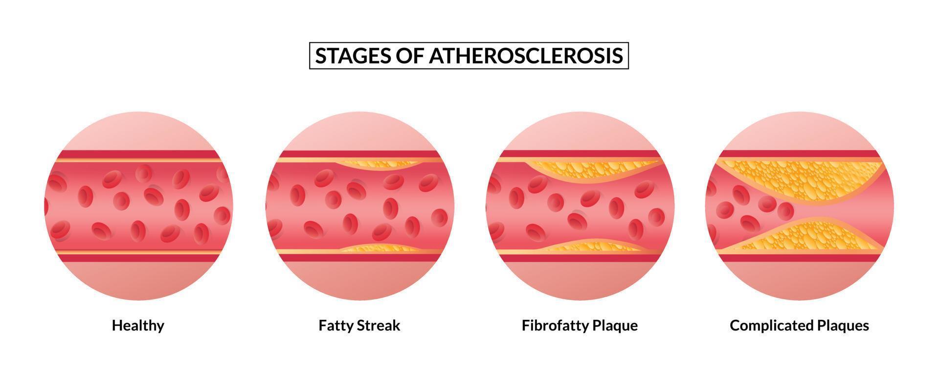 stadier av åderförkalkning. ateroskleros bildning friska artär och ohälsosam artärer. vektor