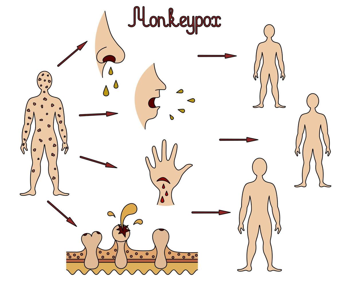 der Übertragungsmechanismus von Affenpocken. Diagramm der Mensch-zu-Mensch-Übertragung des Pockenvirus. Farbvektorillustration. Übertragung durch Körperflüssigkeiten, Hautverletzungen. Virusinfektion. vektor