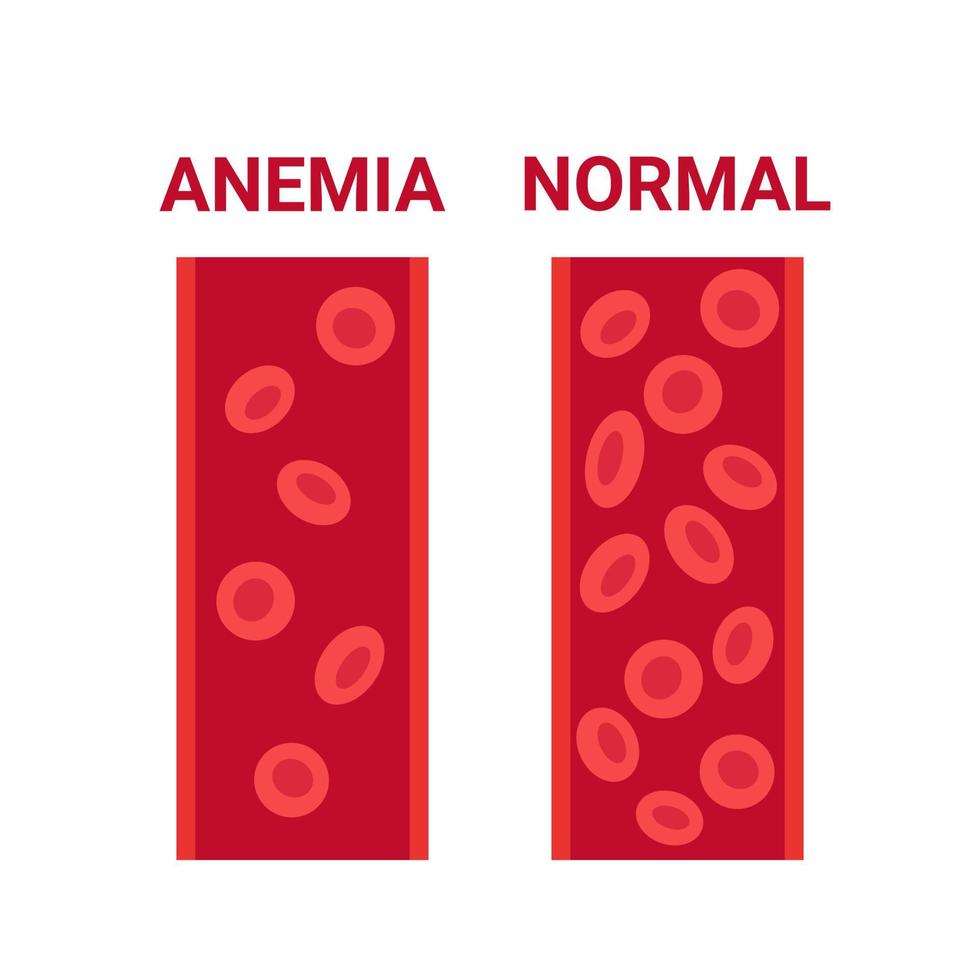 Normal- und Anämieblut im Gefäßvergleich, Anzahl Kreislaufzellen Erythrozyten. niedriger Hämoglobinspiegel, Eisenmangelanämie. Krankheit anämische Blutkörperchen. Gesundheitsproblem. Vektor-Illustration vektor