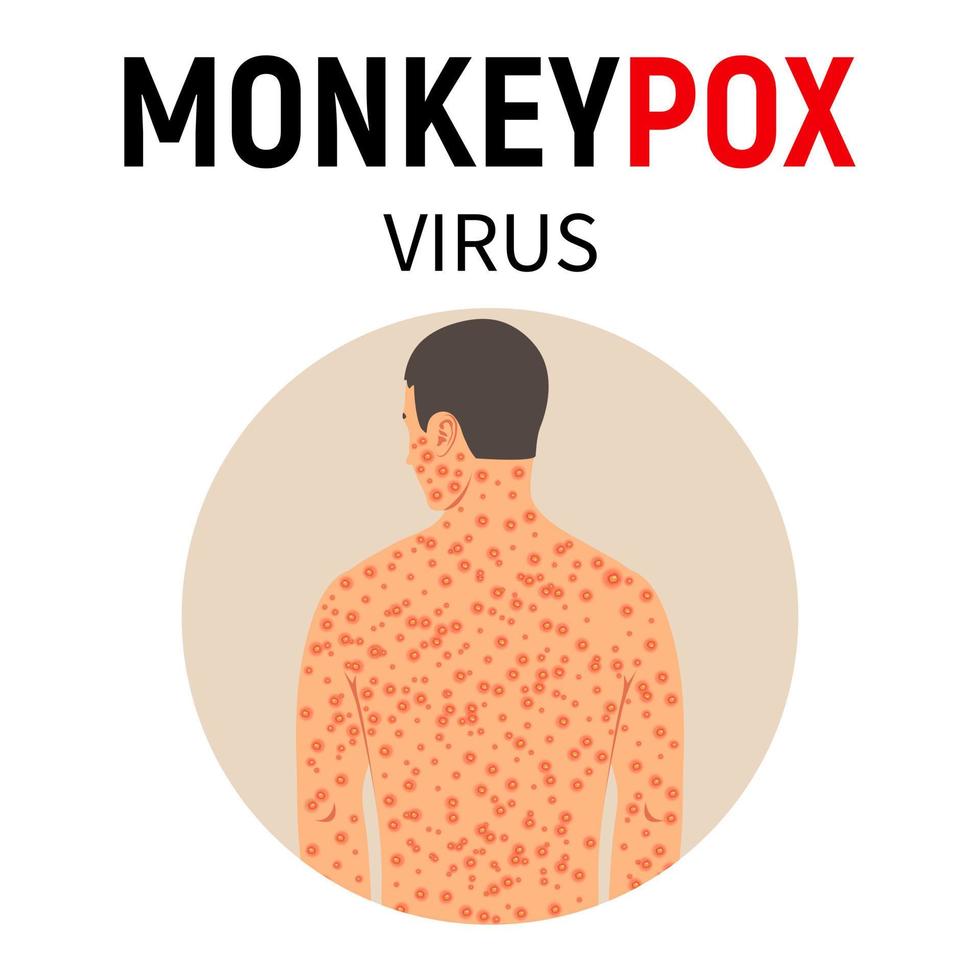 apkoppor virus. en man med apkoppor med en utslag Allt över hans kropp. sjukdom symtom. viral infektion. vektor illustration.