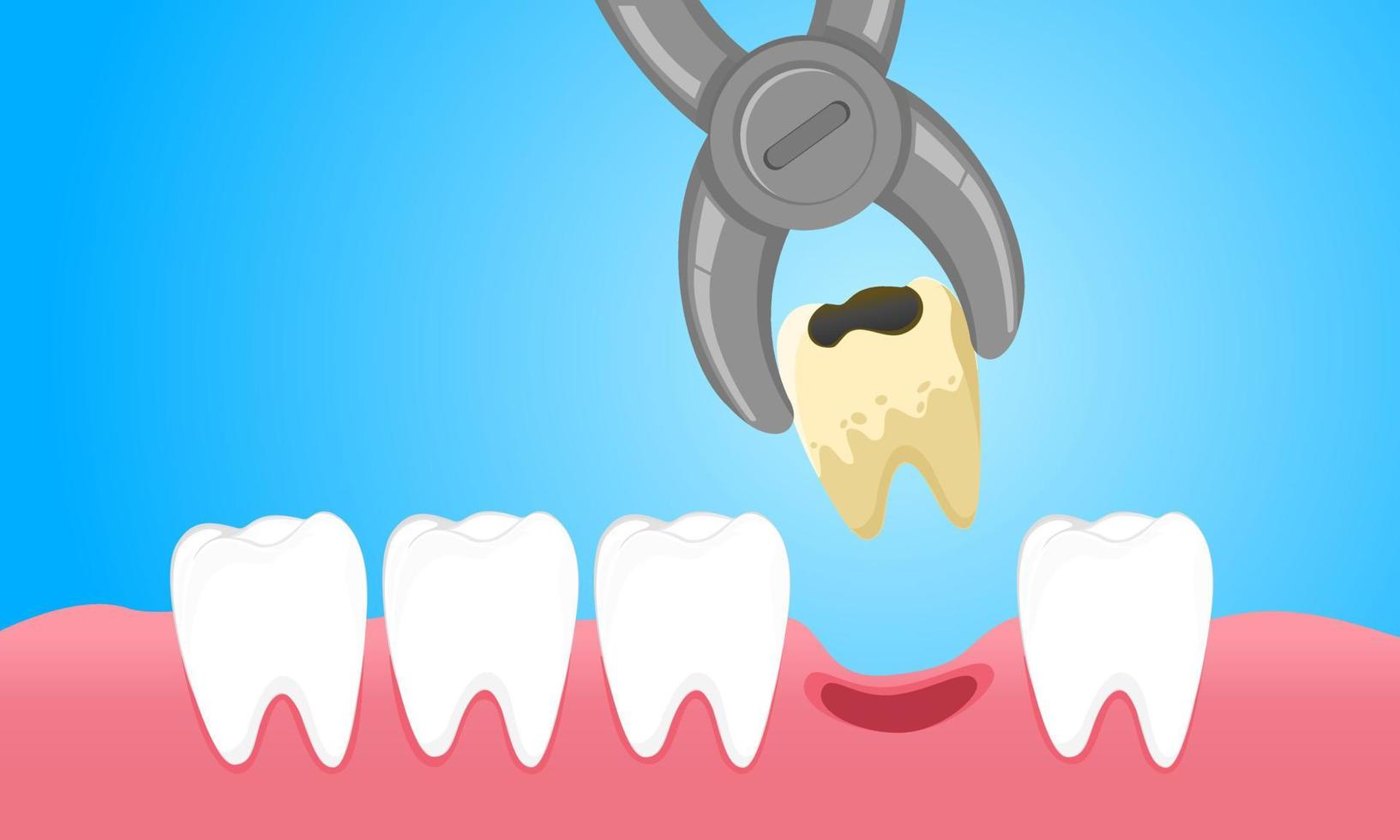 Karies entfernen und Schmerzursachen von geschwollenem Zahnfleisch lindern vektor