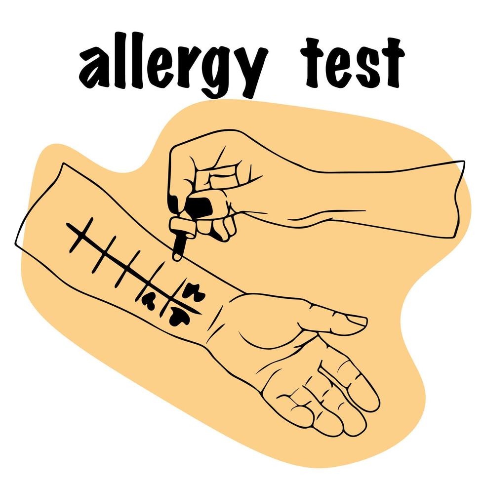 Allergietest. der arzt hält die pipette zur untersuchung in der hand. handfläche nach oben, hautallergietest durchführen. für medizinische Website, Werbung für Medikamente. Patient mit einer allergischen Reaktion. vektor