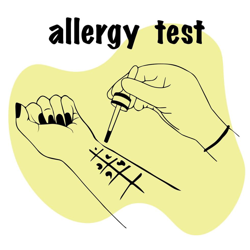 Allergietest. Arzt im Handschuh hält Pipette zur Analyse in der Hand. Handfläche des Patienten mit Tropfen von Allergenen nach oben, führt Hautallergietest durch. Patient mit einer allergischen Reaktion. für medizinische Website vektor