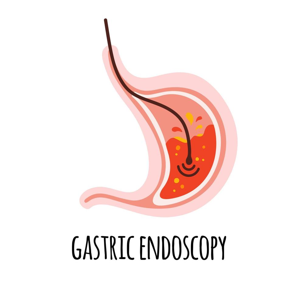 endoskopi. de mage av en person med gastrit. gastroenterologi. vektor illustration i en platt stil.