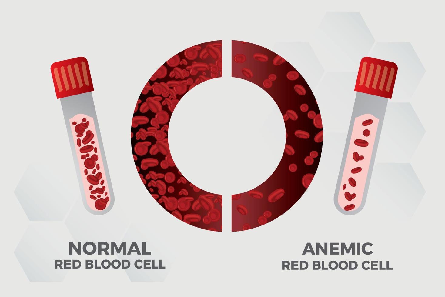 anämie eisen rote blutkörperchen medizinische vektorillustration medizinisch. vektor