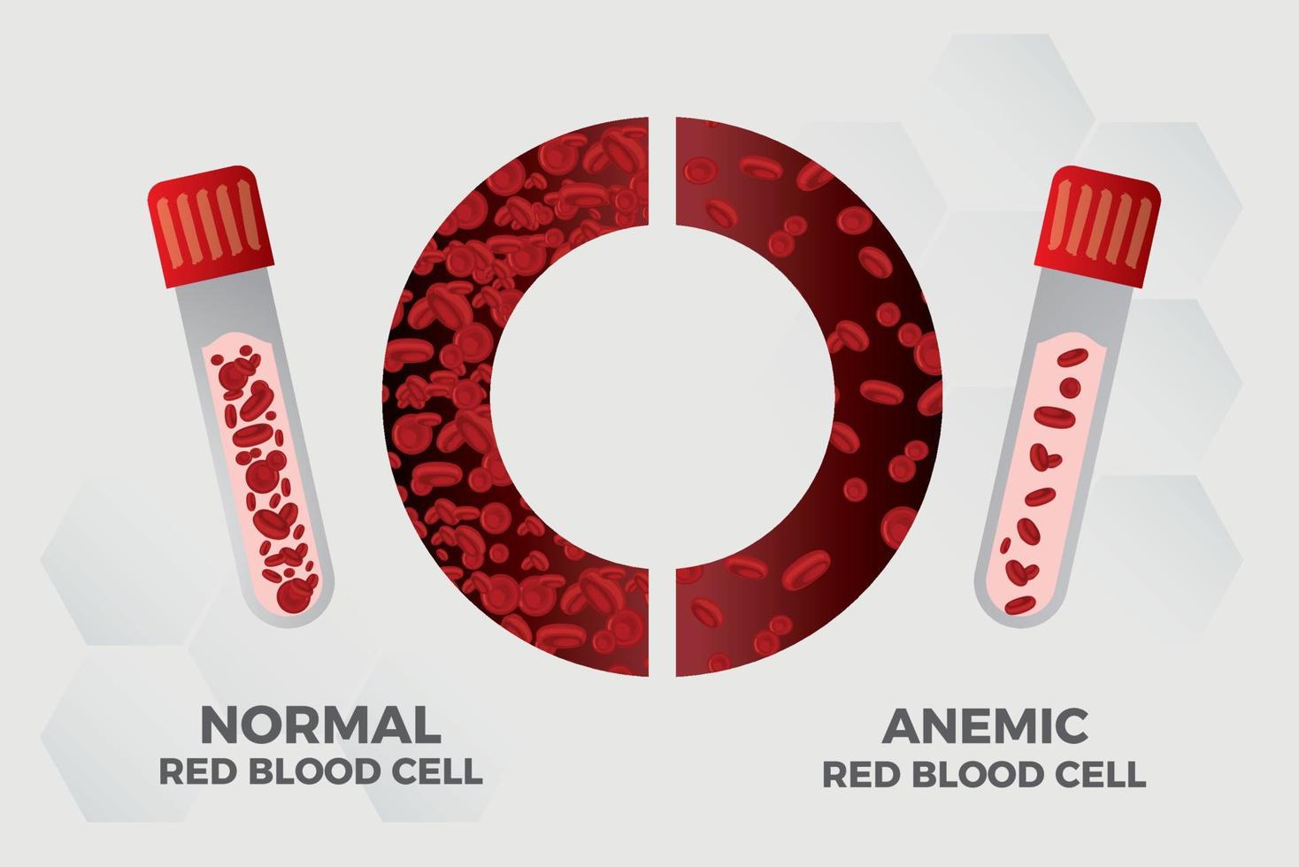 anemi järn röd blod cell medicinsk vektor illustration medicinsk.
