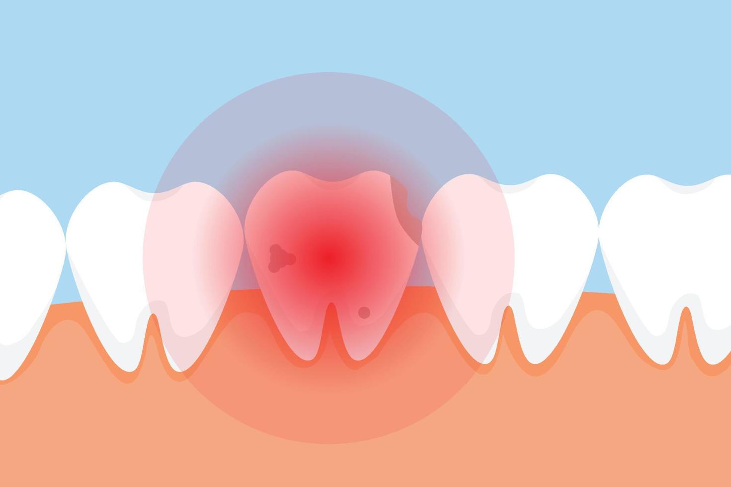 död tand gör ont och ger en röd smärtsignal koncept. en dålig tand med hål och en röd farosignal. dental infographic element vektor med en död tand. stomatologisk vård för tänder.