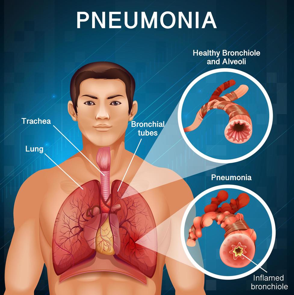 Mann mit Lungenentzündung mit schlechten Lungen im menschlichen Körper vektor