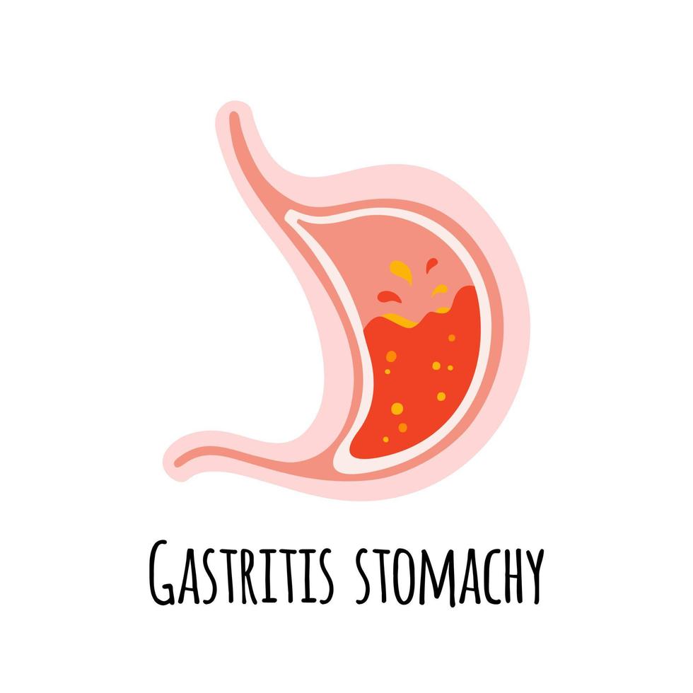 der Magen einer Person mit Gastritis. Gastroenterologie. vektorillustration in einem flachen stil. vektor