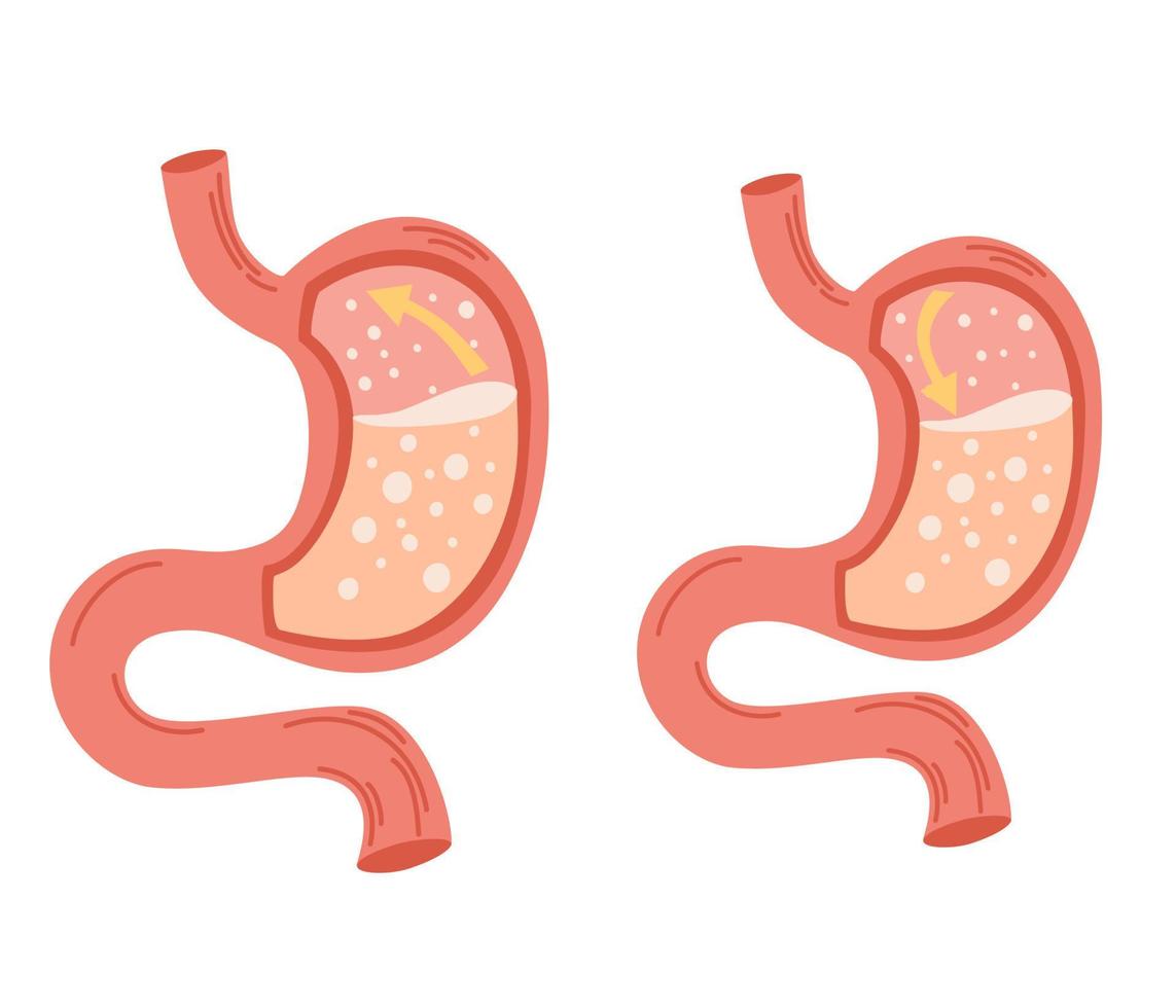 menschlicher Magen eingestellt. Konzept der gastroösophagealen Refluxkrankheit. ungesundes magenkonzept. Sodbrennen, Krankheit, Unbehagen, Schmerzen. flache vektorillustration lokalisiert auf weiß vektor