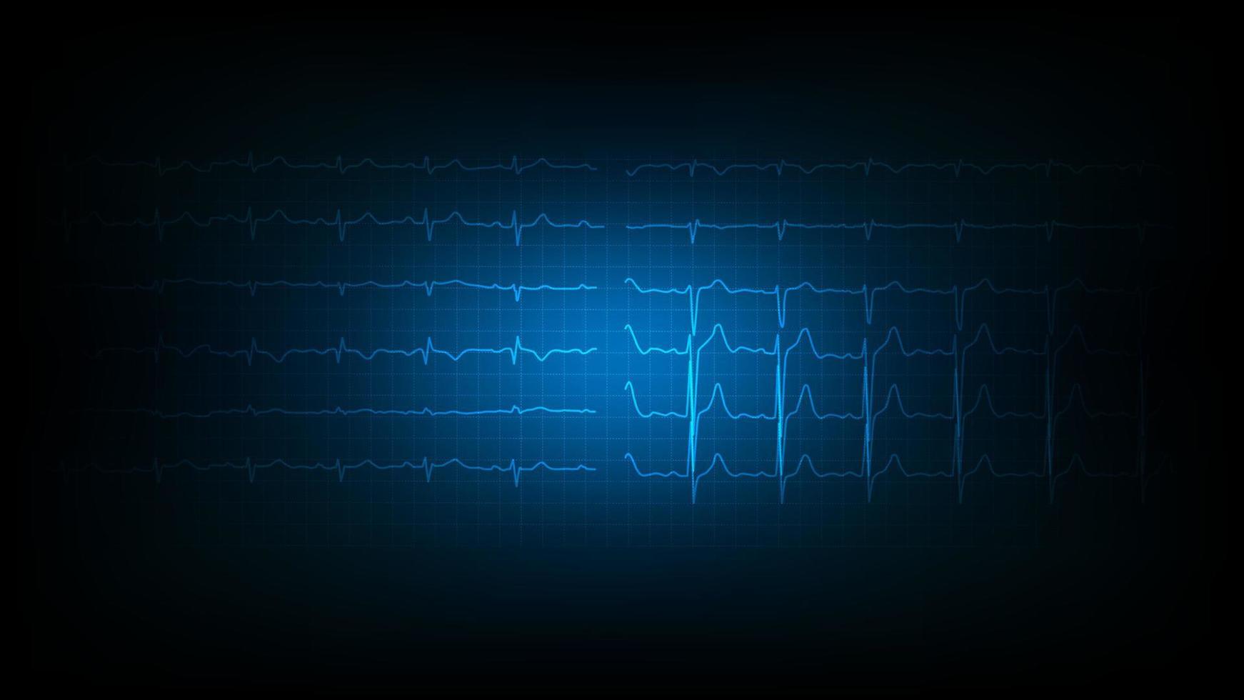 Abbildung von Herzwellen oder Elektrokardiographie auf der Bildschirmüberwachung. vektor