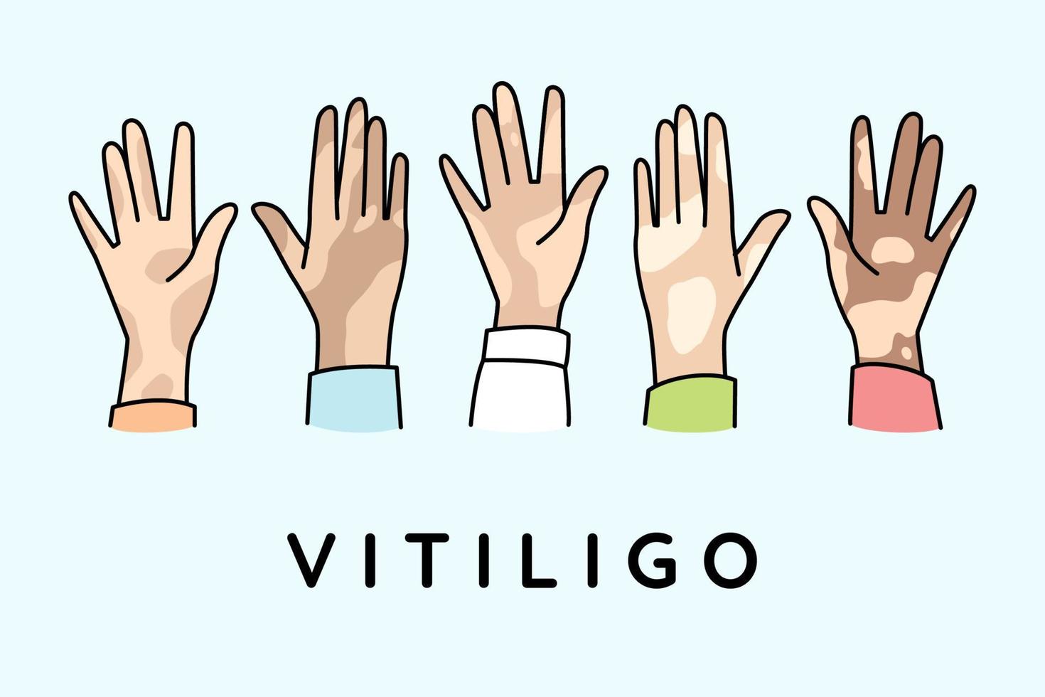 olika händer av människor lida från vitiligo sjukdom. människor kamp med pigmentering på kropp. värld vitiligo dag begrepp. vektor illustration.