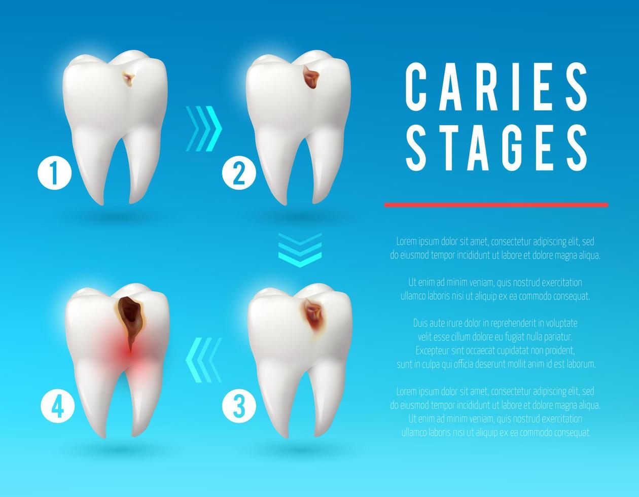 tand förfall 3d affisch av dental karies utveckling vektor