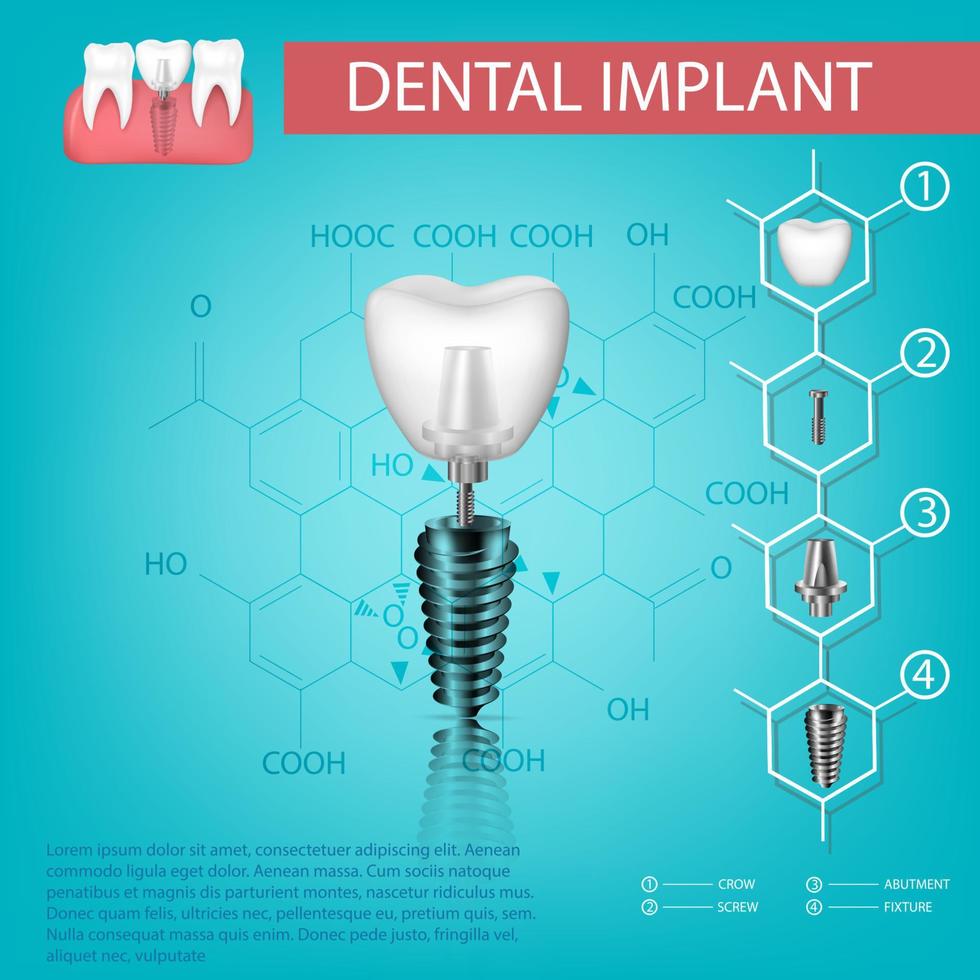 vektor realistisk tand. strukturell element av en dental implantera. infographic för medicinsk affisch.