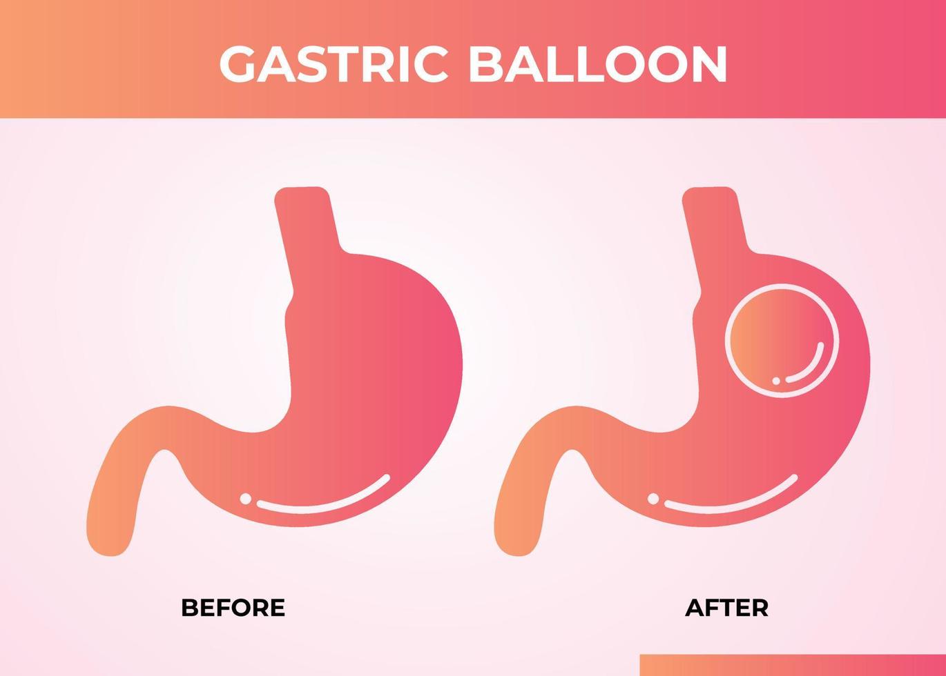 Magen-Endoskopie Magenballon in einem Magen Gewichtsverlust Chirurgie Vektor-Illustration Adipositas vektor