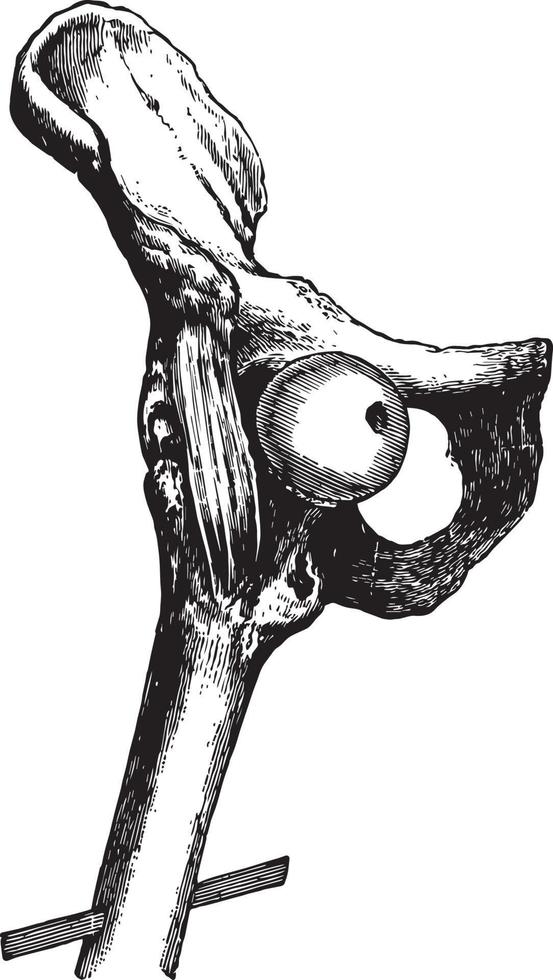 Hüftluxation auf den Schamhaaren, Vintage-Illustration. vektor