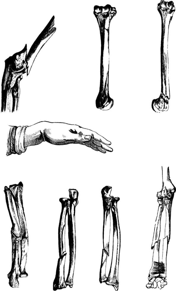 fractured ben, årgång illustration. vektor