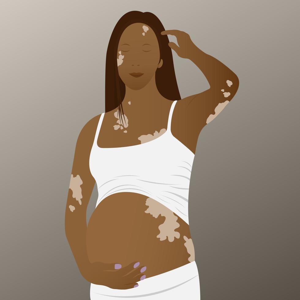 junge, schwangere Frau mit Vitiligo auf der Haut. schönheitsdiversitätskonzept, positiver körper, selbstakzeptanz, bewusstsein für chronische hautkrankheiten, illustration vektor