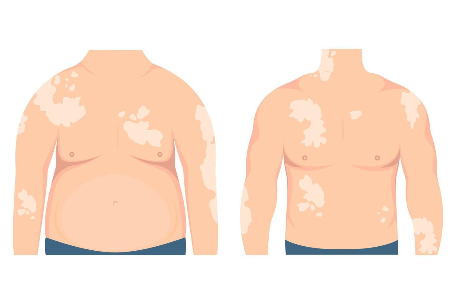 fett och tunn man med vitiligo plåster på de hud. skönhet mångfald begrepp, kropp positiv, kronisk hud sjukdom medvetenhet, illustration vektor