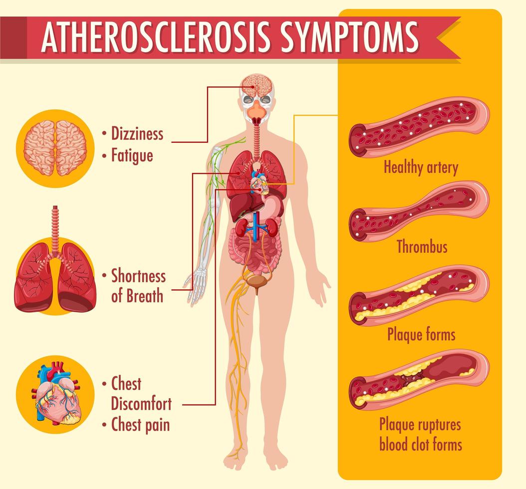 Stadien der Atherosklerose Infografik vektor