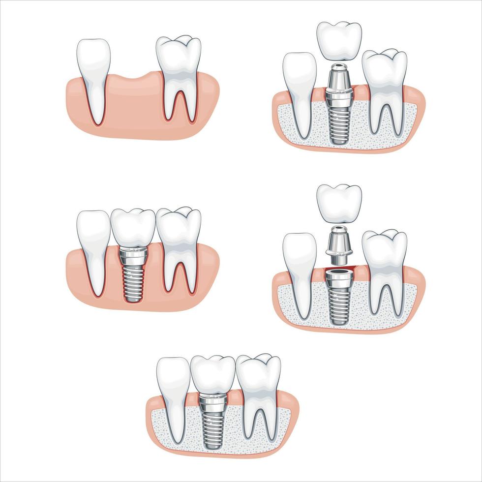 tand krona illustration, friska tänder, tandläkare vektor illustration, oral vård