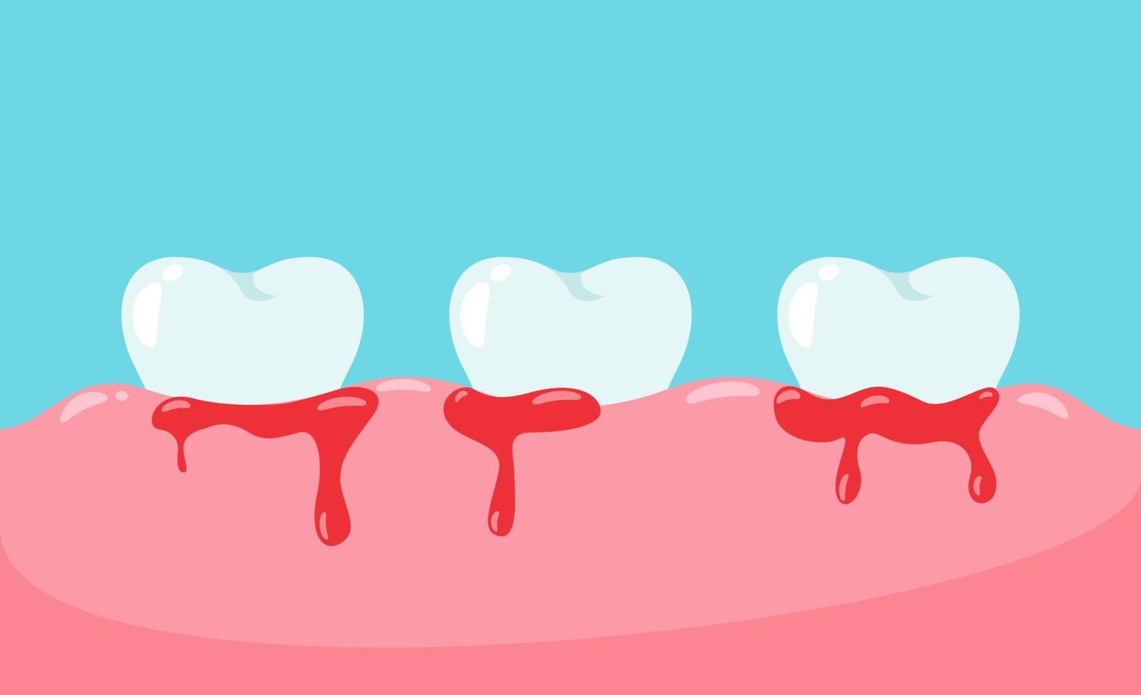 Zahnbluten auf dem Zahnfleischvektor vektor