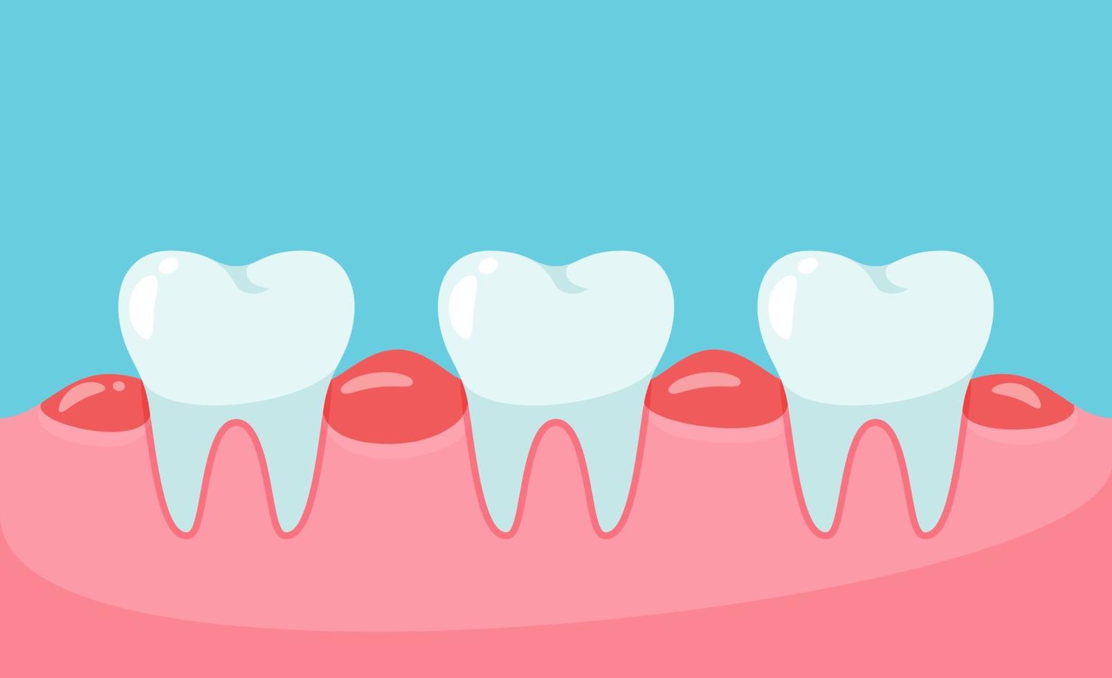 Vektor geschwollene Zähne. ungesundes Zahnfleisch