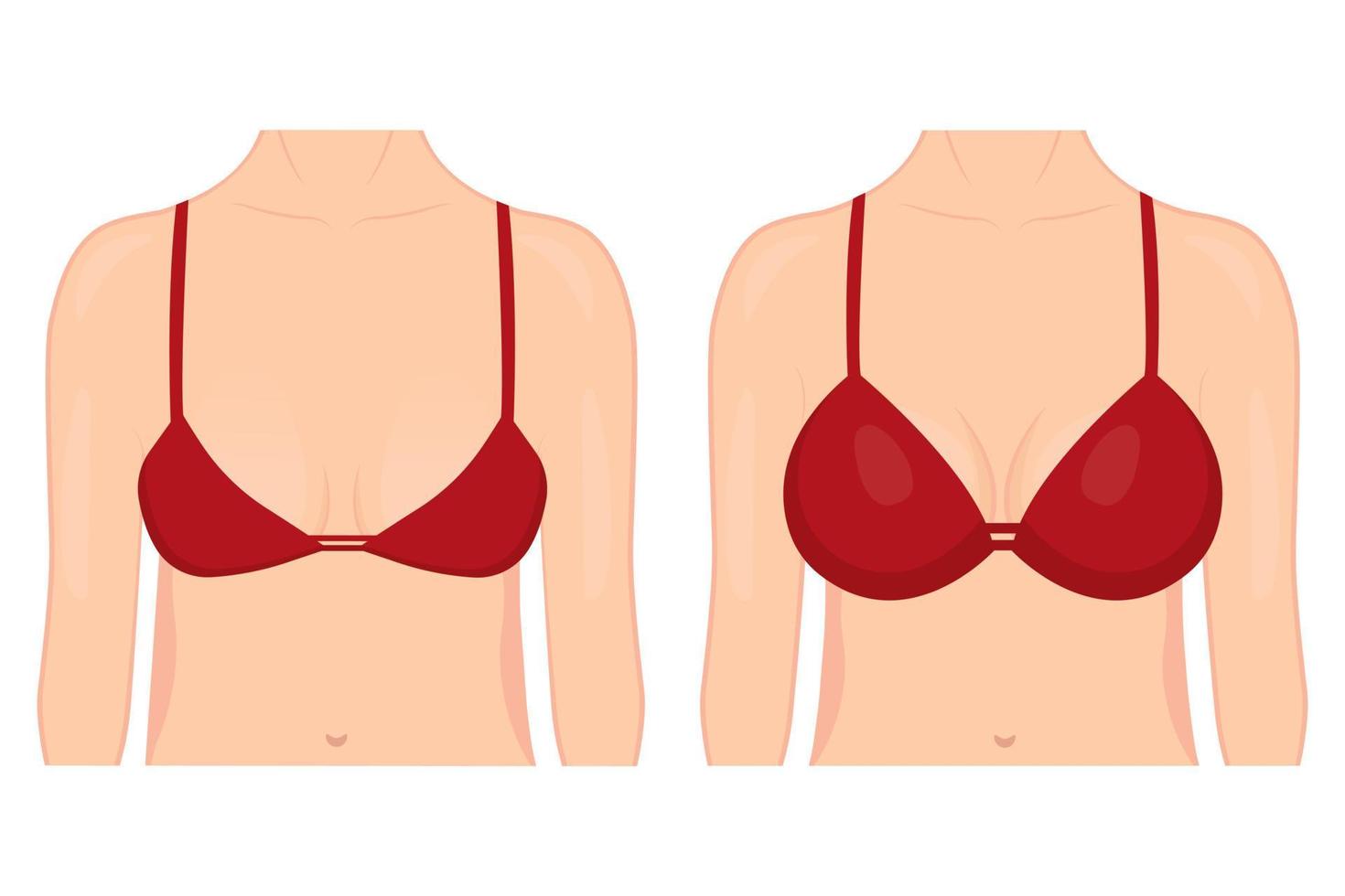 sätta dit av en kvinna innan och efter plast kirurgi för bröst förstärkning. en kvinna i en behå med annorlunda bröst storlekar på en vit bakgrund. för reklam och medicinsk publikationer. vektor